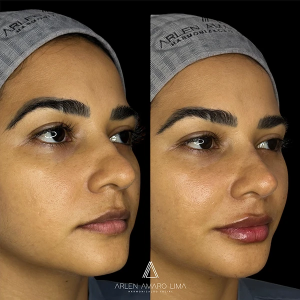 ANTES E DEPOIS 001