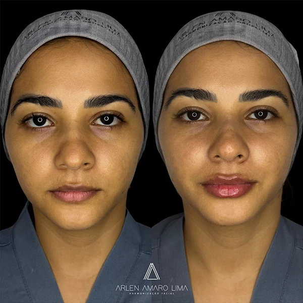 ANTES E DEPOIS 002
