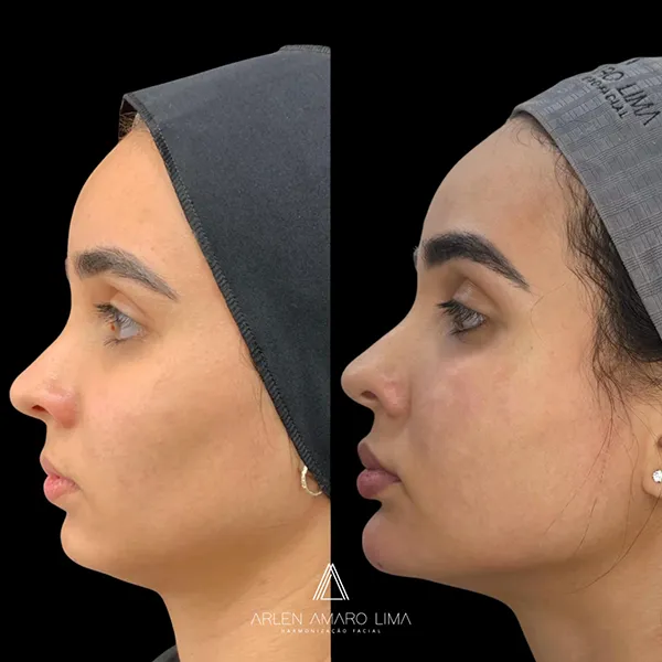 ANTES E DEPOIS 003