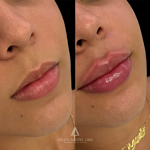ANTES E DEPOIS 004