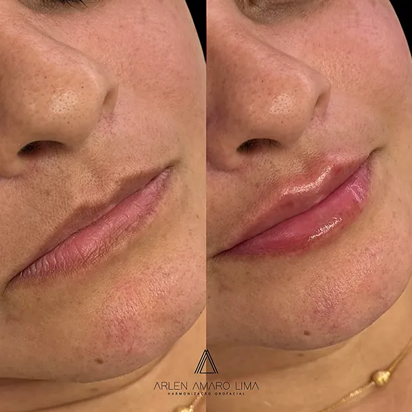 ANTES E DEPOIS 005