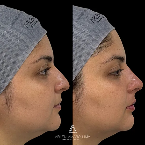 ANTES E DEPOIS 006