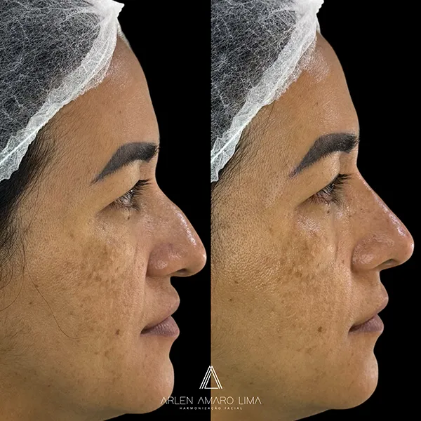 ANTES E DEPOIS 007