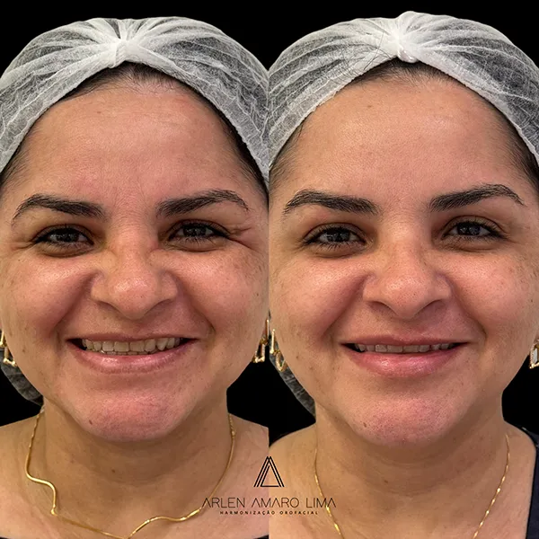 ANTES E DEPOIS 008