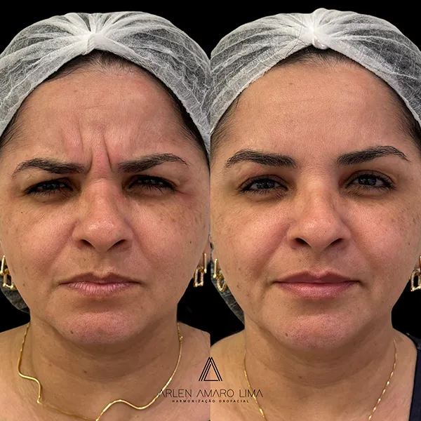 ANTES E DEPOIS 009