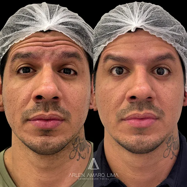 ANTES E DEPOIS 010
