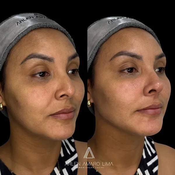 ANTES E DEPOIS 011