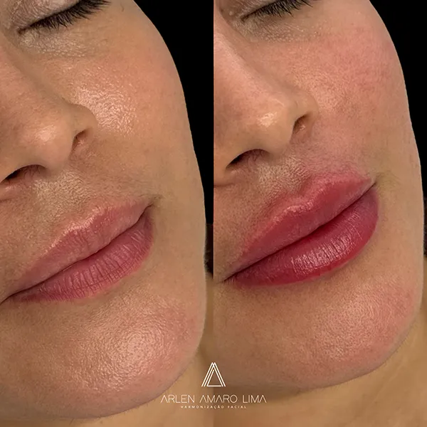 ANTES E DEPOIS 012