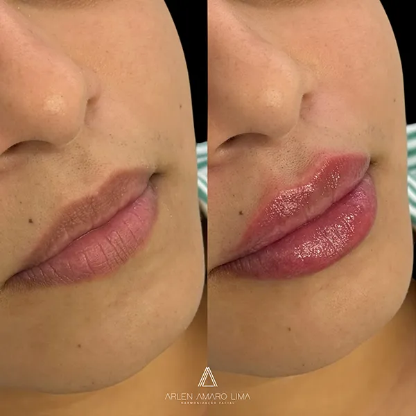 ANTES E DEPOIS 013