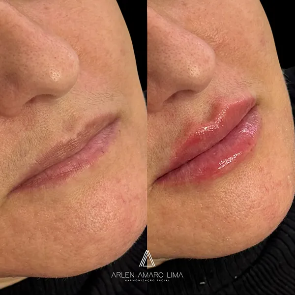 ANTES E DEPOIS 014