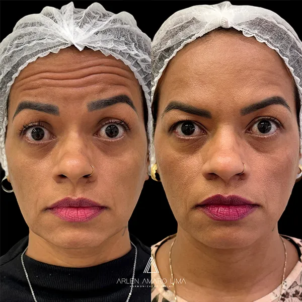 ANTES E DEPOIS 015