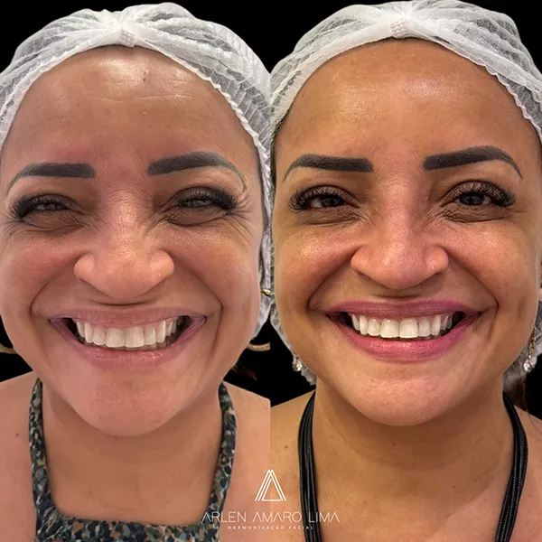 ANTES E DEPOIS 016