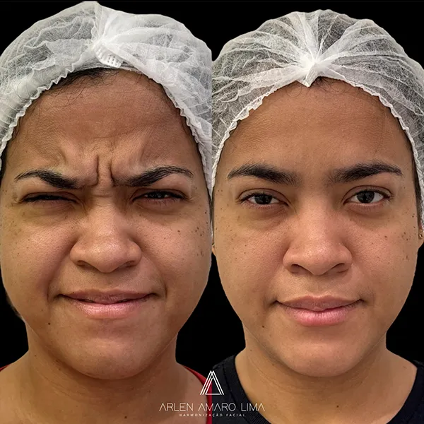 ANTES E DEPOIS 017