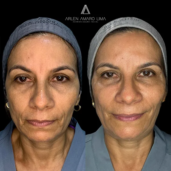 ANTES E DEPOIS 018