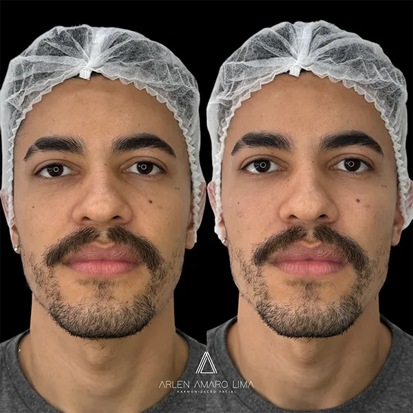 ANTES E DEPOIS 019