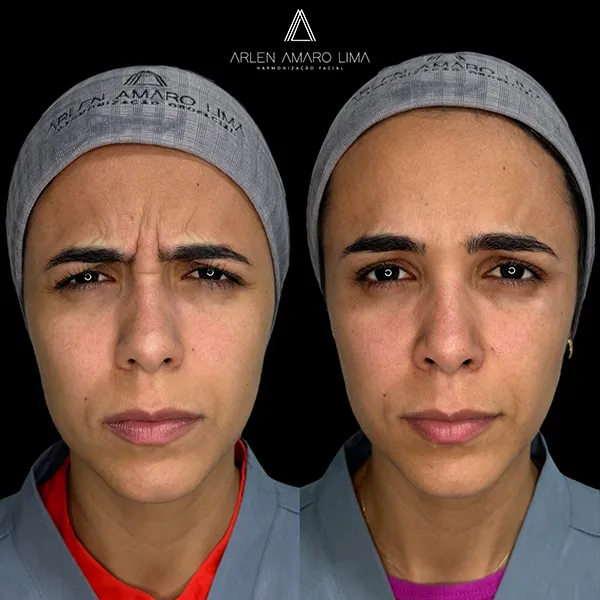 ANTES E DEPOIS 020