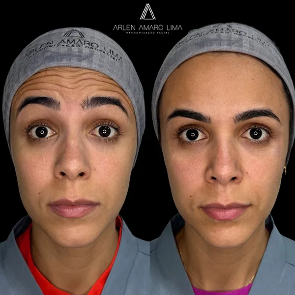 ANTES E DEPOIS 021