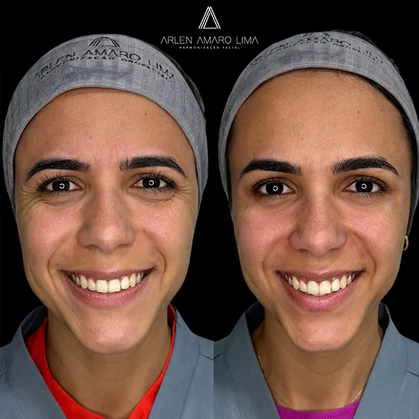 ANTES E DEPOIS 022