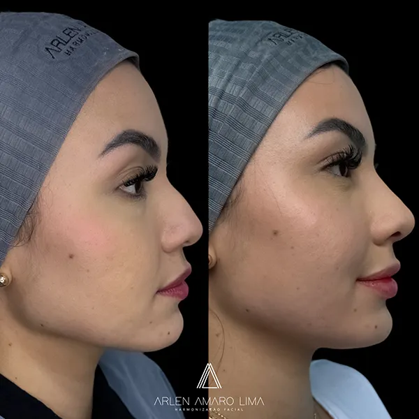 ANTES E DEPOIS 023