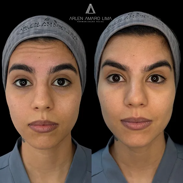ANTES E DEPOIS 024
