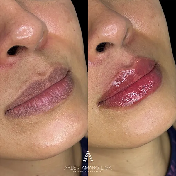 ANTES E DEPOIS 025