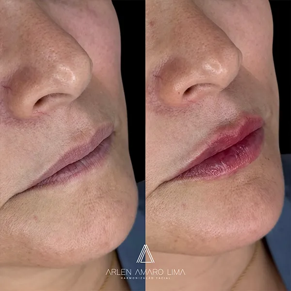 ANTES E DEPOIS 026