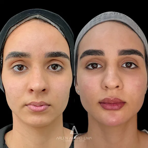 ANTES E DEPOIS 027