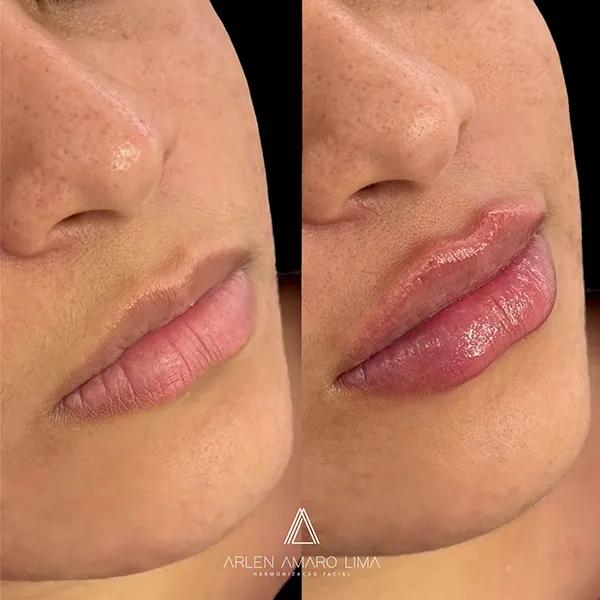 ANTES E DEPOIS 028