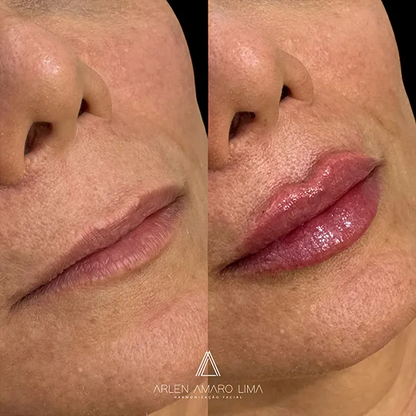 ANTES E DEPOIS 029